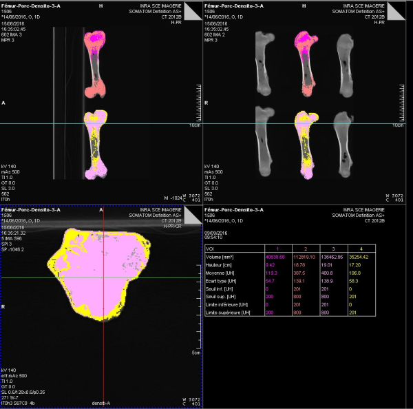 CT-scan qualité de l'os